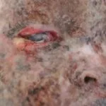 xeroderma-pigmentosum-07__protectwyjqcm90zwn0il0_focusfillwzi5ncwymjisinkildg1xq-8773632-8136444-jpg-4485077