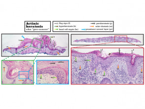 Histopatología de la queratosis actínica