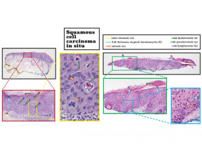 Histopatología del carcinoma de células escamosas in situ
