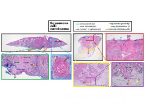 Histopatología del carcinoma de células escamosas