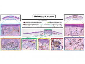Histopatología del nevus melanocítico