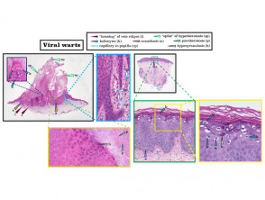 Histopatología de la verruga viral