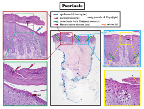 Histopatología de la psoriasis