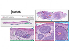 Histopatología del carcinoma basocelular