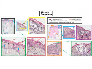 Histopatología de la micosis fungoide