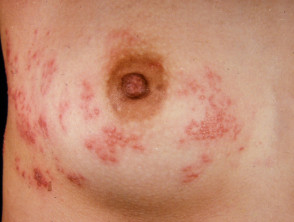 Infección de herpes